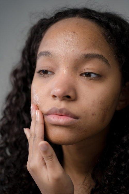 Hormonal Acne and Hyperpigmentation: Understanding, Treating, and Supporting Hormonal Balance Naturally